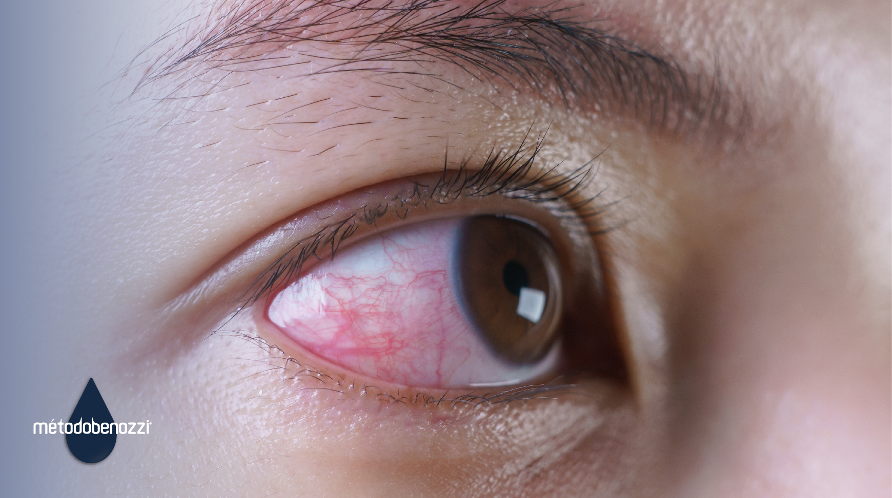 Glaucoma: síntomas y posibles tratamientos