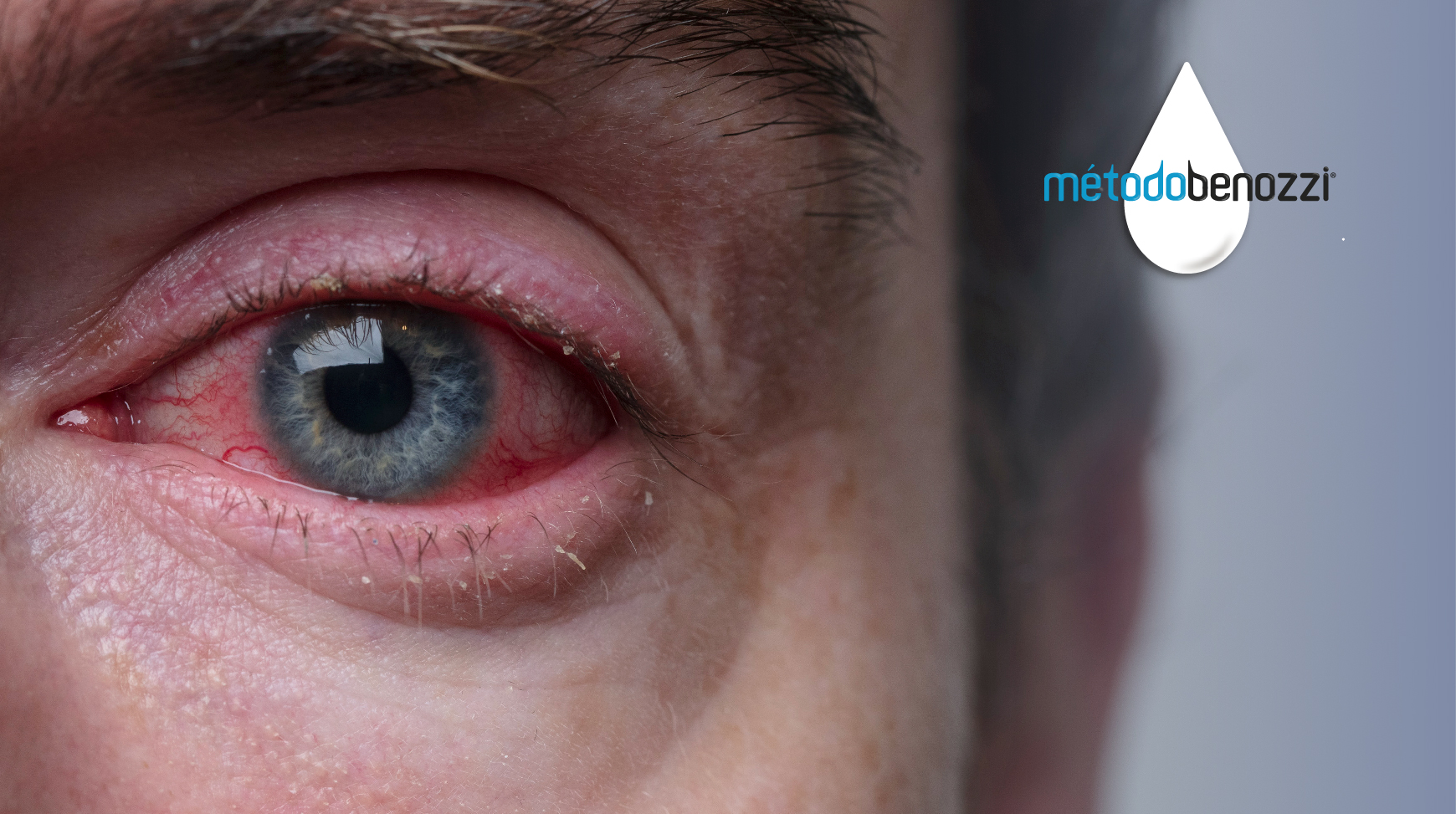 ¿Cuándo aparece la retinopatía diabética?