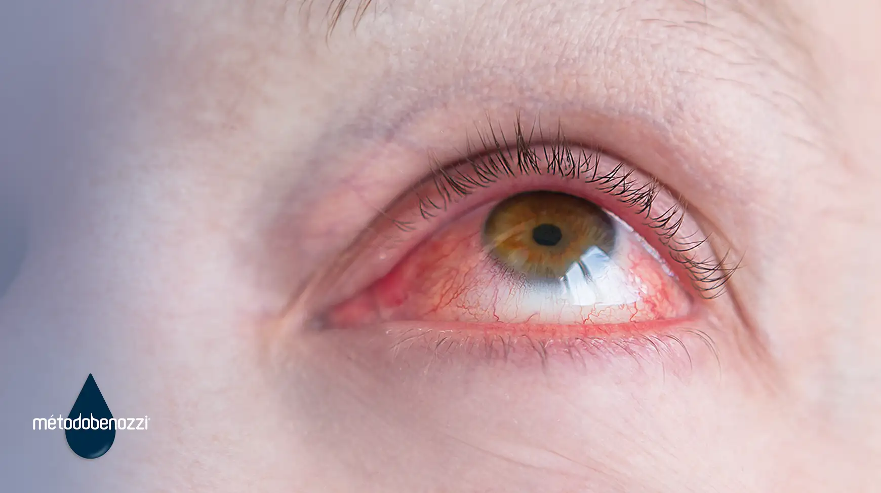 ¿Qué tipos de queratitis hay?