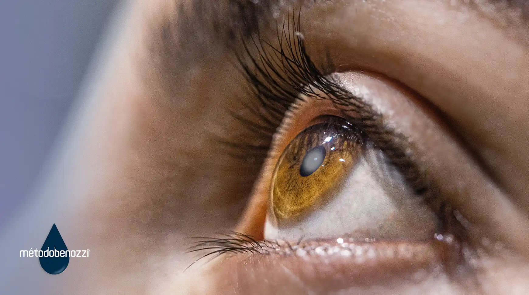 Cataratas: desarrollo, tratamientos y prevención